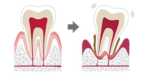 歯周病治療