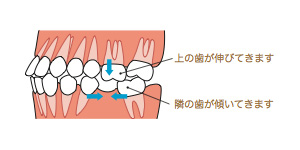 欠損治療